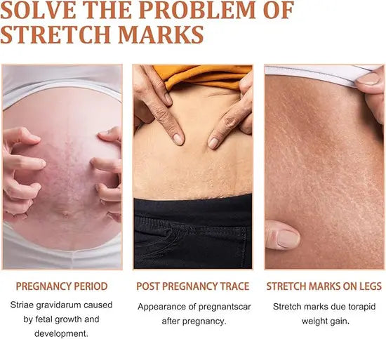 Eelhoe - Stretch Marks Removal Cream (Original) uniglow