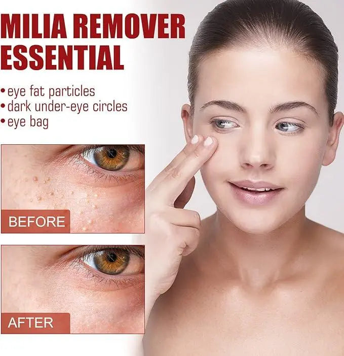Smooth Milia Remover Serum Gentle Treatment for Clear, Smooth Skin - Uniglowstore